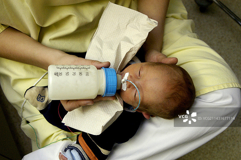 患黄疸的早产儿图片素材