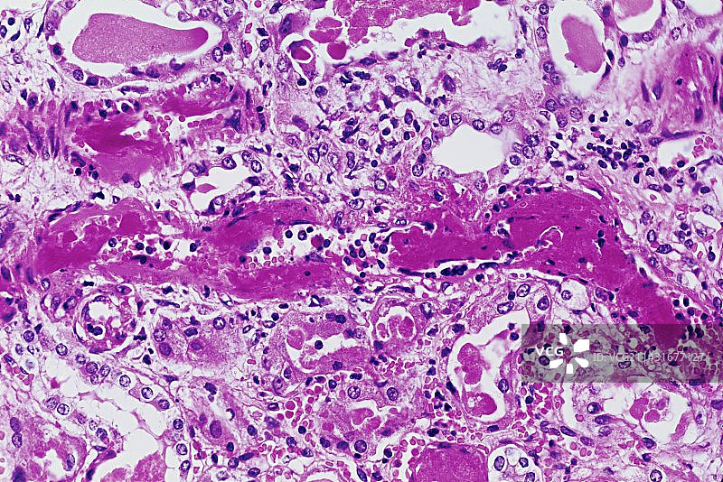 肾性高血压（光学显微照片）图片素材