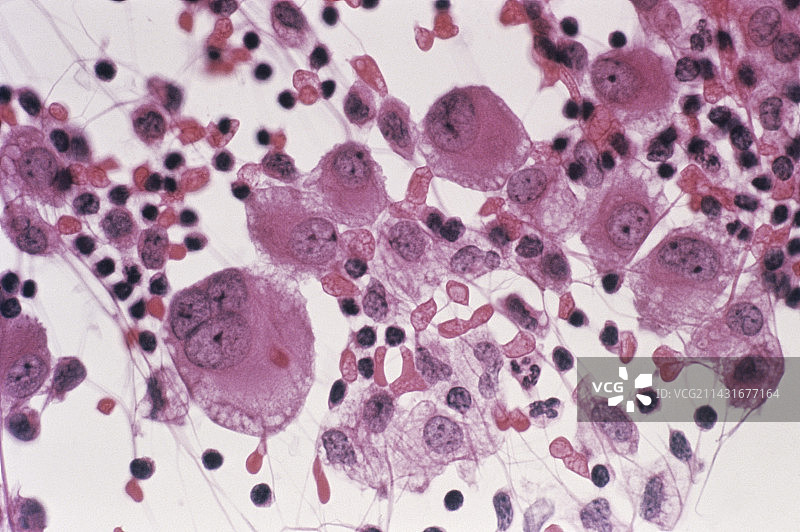 肺部增生图片素材