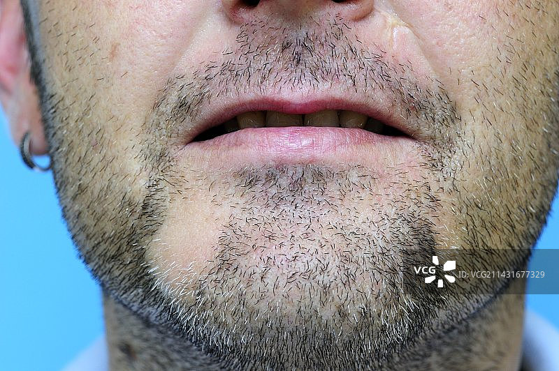 下巴上的脱发（斑秃）图片素材