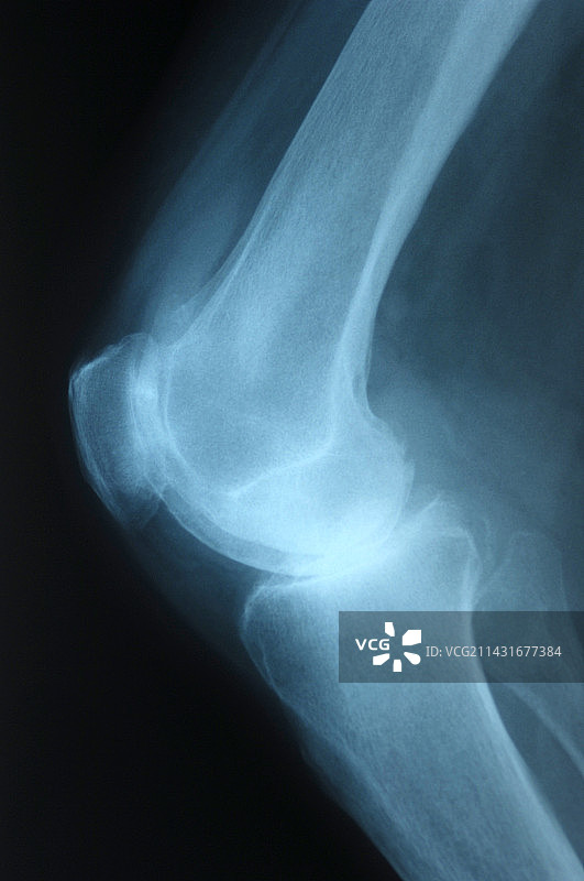 关节炎膝盖X光片图片素材