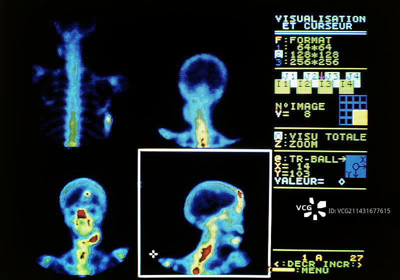 显示骨癌的颅骨和脊柱伽马扫描图片素材