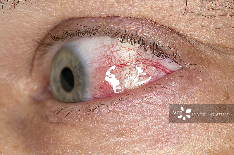 发炎的眼白图片素材