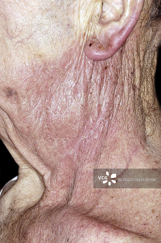 放射疗法灼伤图片素材