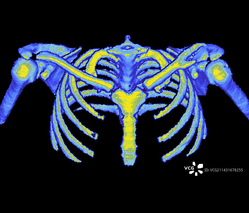 肋骨CT扫描图片素材