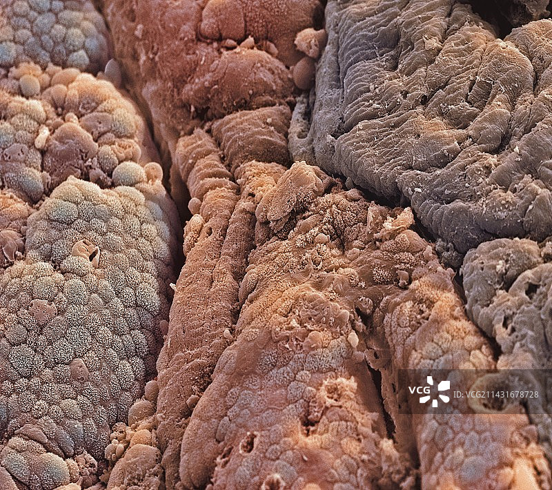 结肠癌，扫描电子显微镜图片素材