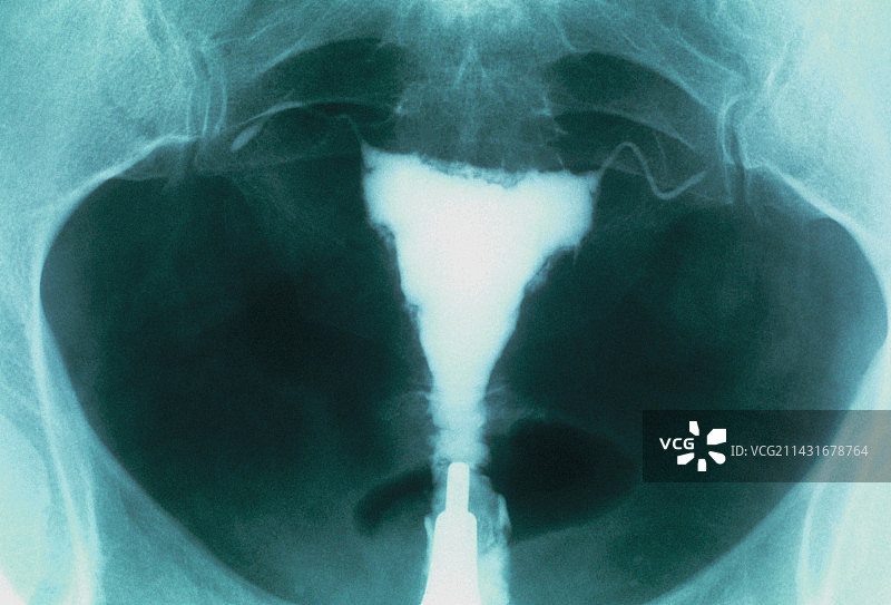 绝经后子宫X光片图片素材