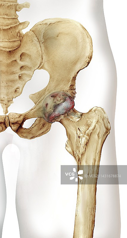 关节炎髋部插画图片素材