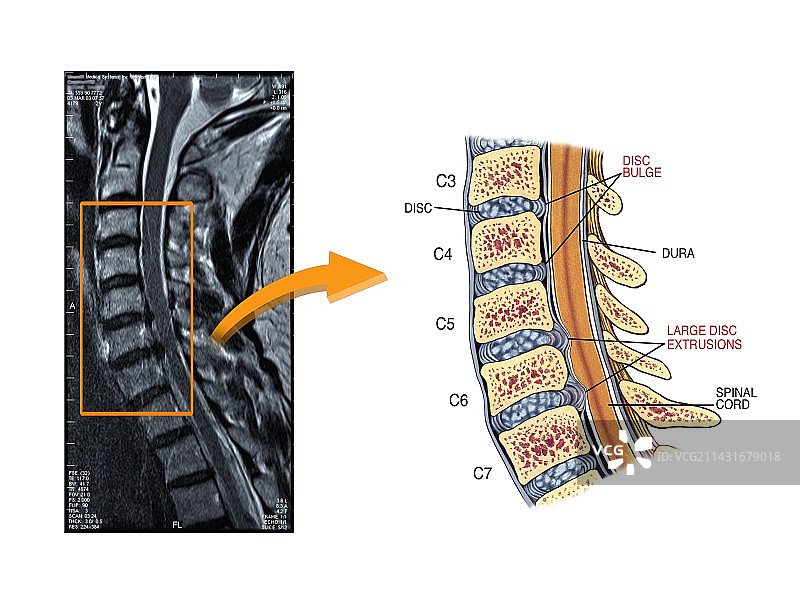 颈椎间盘滑脱图片素材