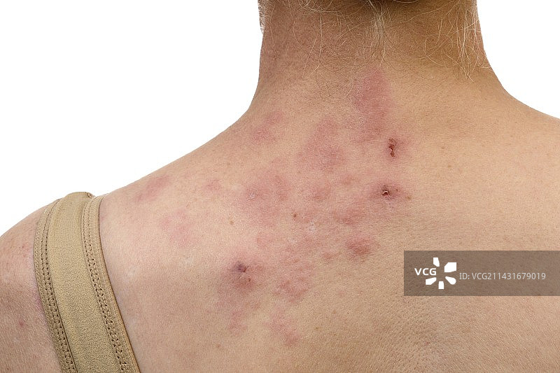 颈部带状疱疹图片素材