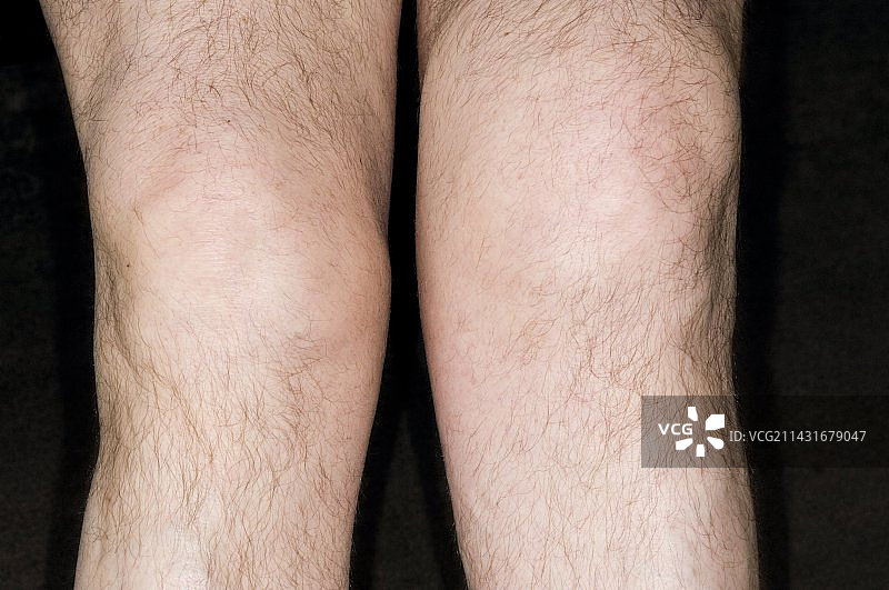 膝盖肿胀图片素材