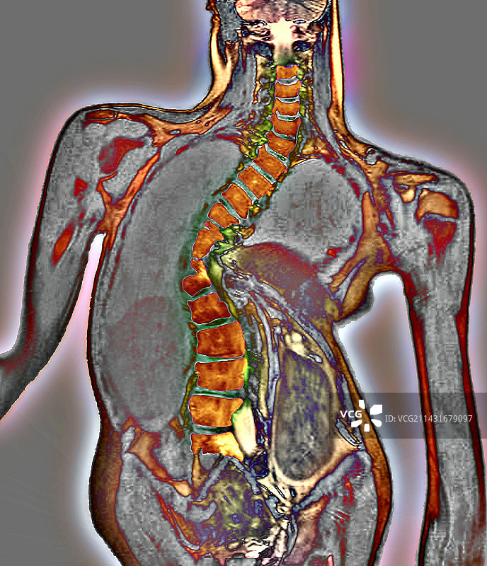 脊柱弯曲核磁共振扫描图片素材