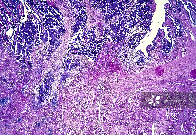 卵巢肿瘤，光学显微照片图片素材