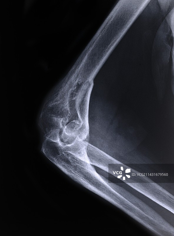 肘部骨折X光片图片素材
