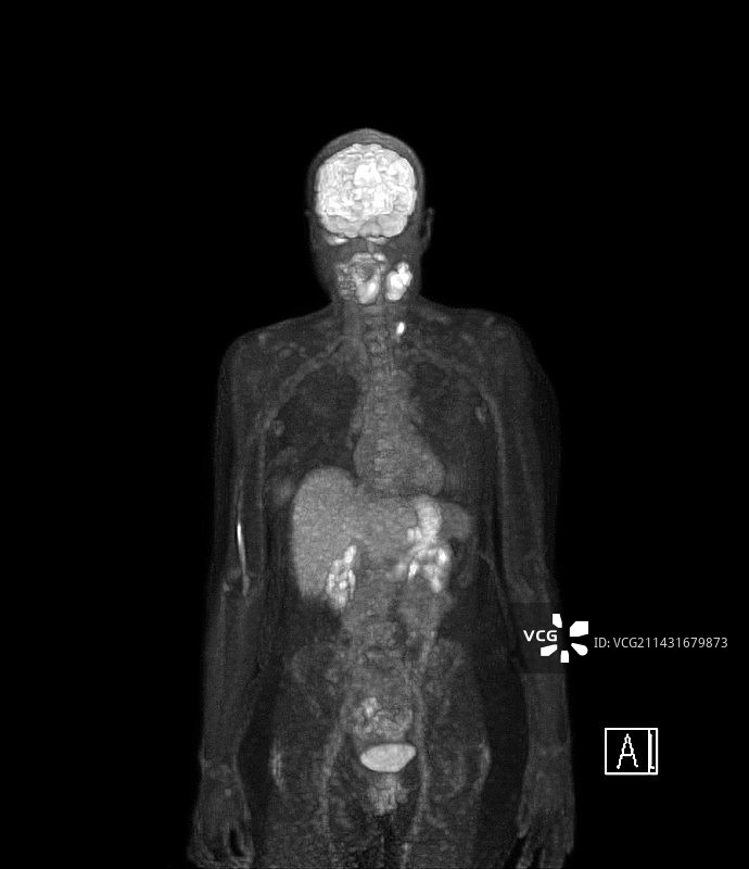 咽癌，PET扫描图片素材
