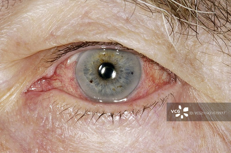 发炎的虹膜图片素材