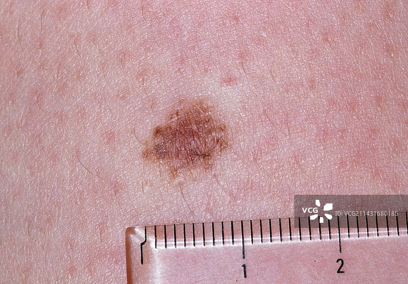 人体皮肤上的皮内痣图片素材