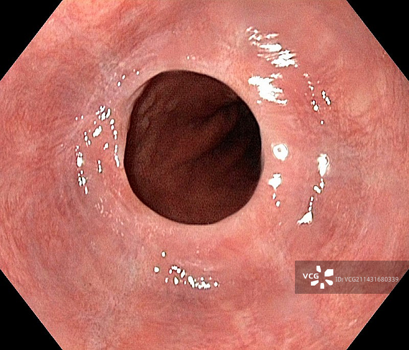 食管蹼内窥镜视图图片素材