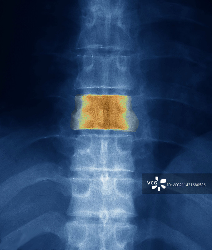 霍奇金淋巴瘤X光片图片素材