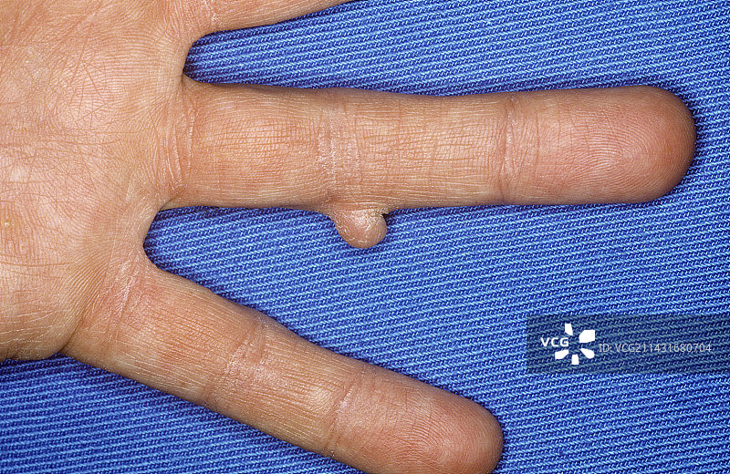 手指上的纤维瘤图片素材
