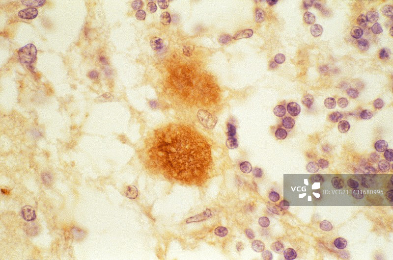 克雅氏病患者的大脑图片素材