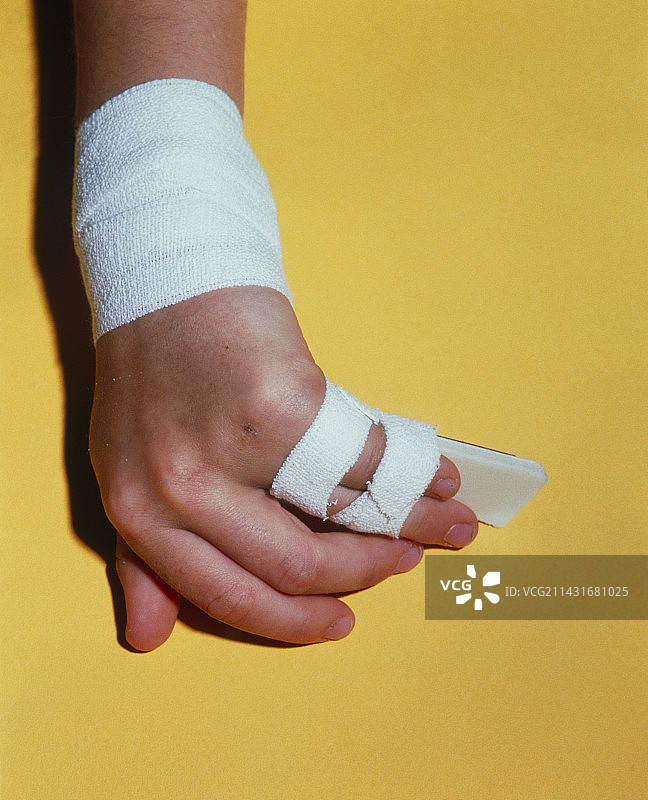 绷带和夹板固定的小拇指骨折图片素材