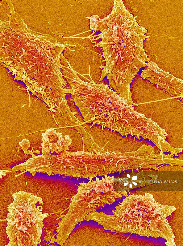 结肠癌细胞（扫描电子显微镜）图片素材