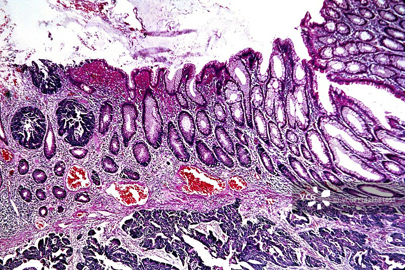 结肠癌显微照片图片素材