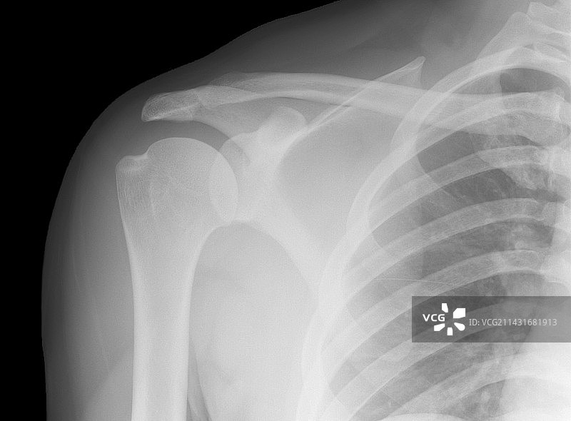 正常肩部X光片图片素材