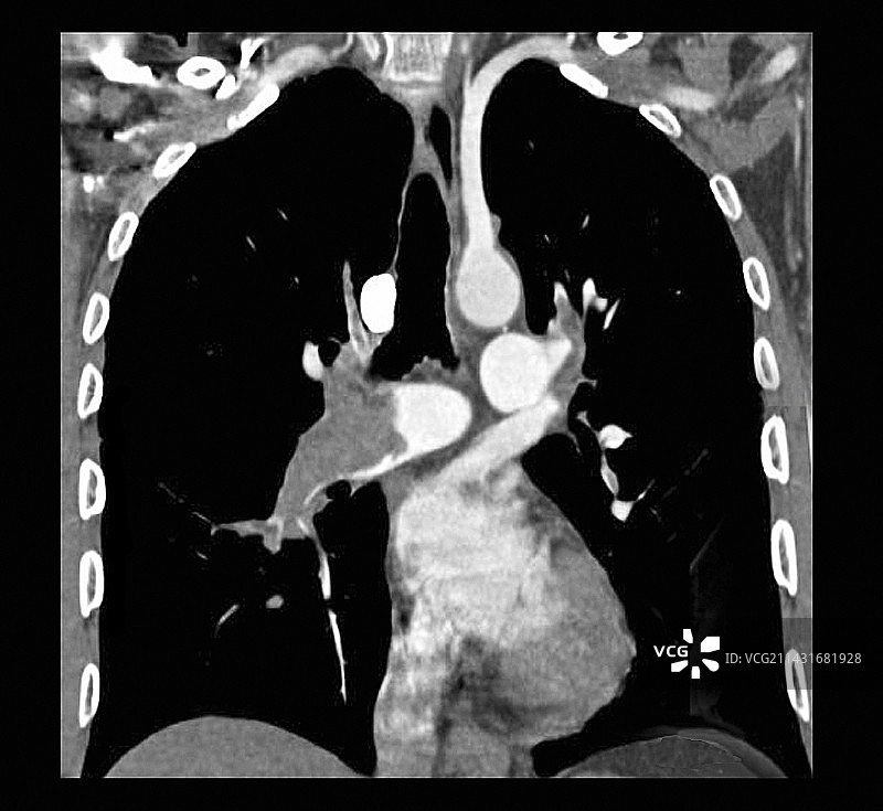肺栓塞CT扫描图片素材