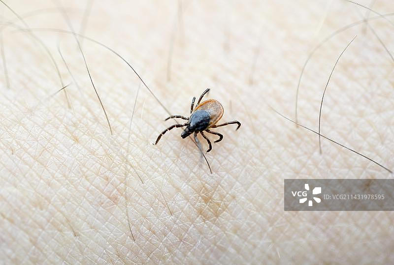 在人体皮肤上爬行的蓖麻豆蜱虫（硬蜱）图片素材