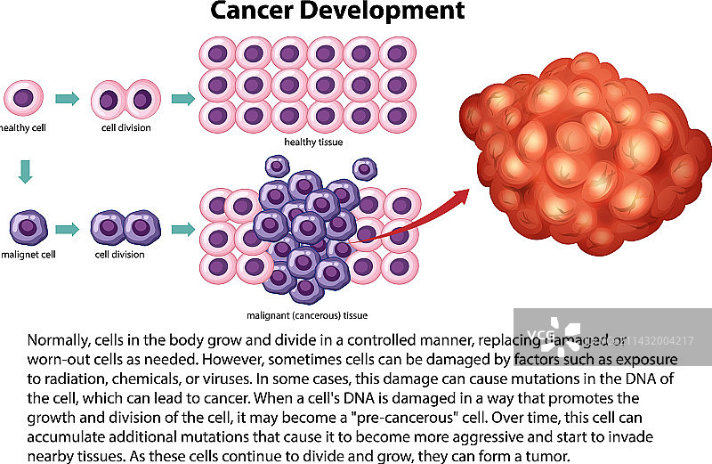 癌症发展信息图片素材