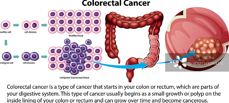 结直肠癌科普说明图片素材