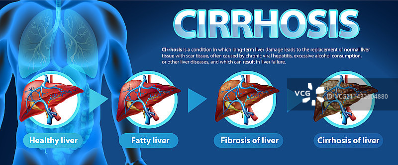 酒精性肝病科普海报图片素材