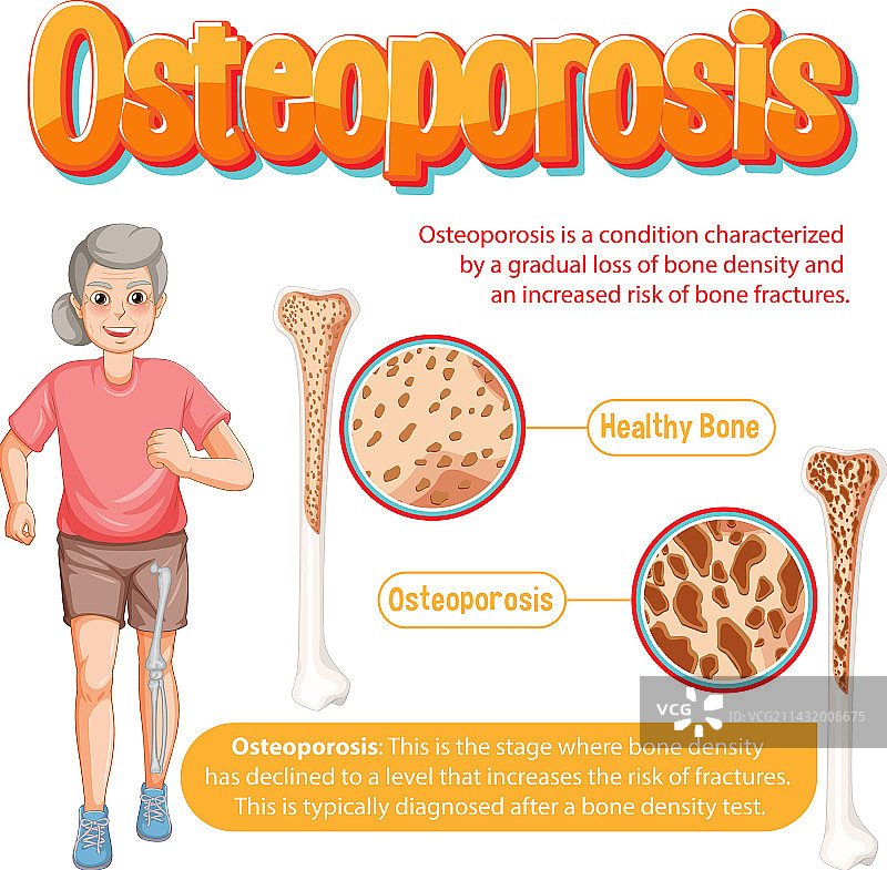 骨质疏松症人体骨骼信息海报图片素材