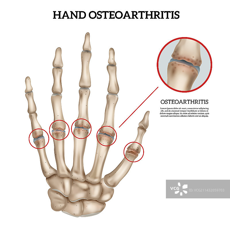 手部骨关节炎解剖信息图图片素材