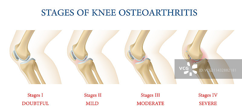 膝关节骨关节炎阶段信息图图片素材