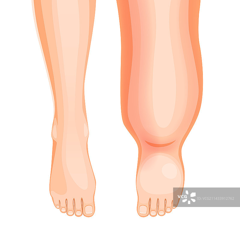 水肿足部疾病肿胀腿部症状或问题图片素材