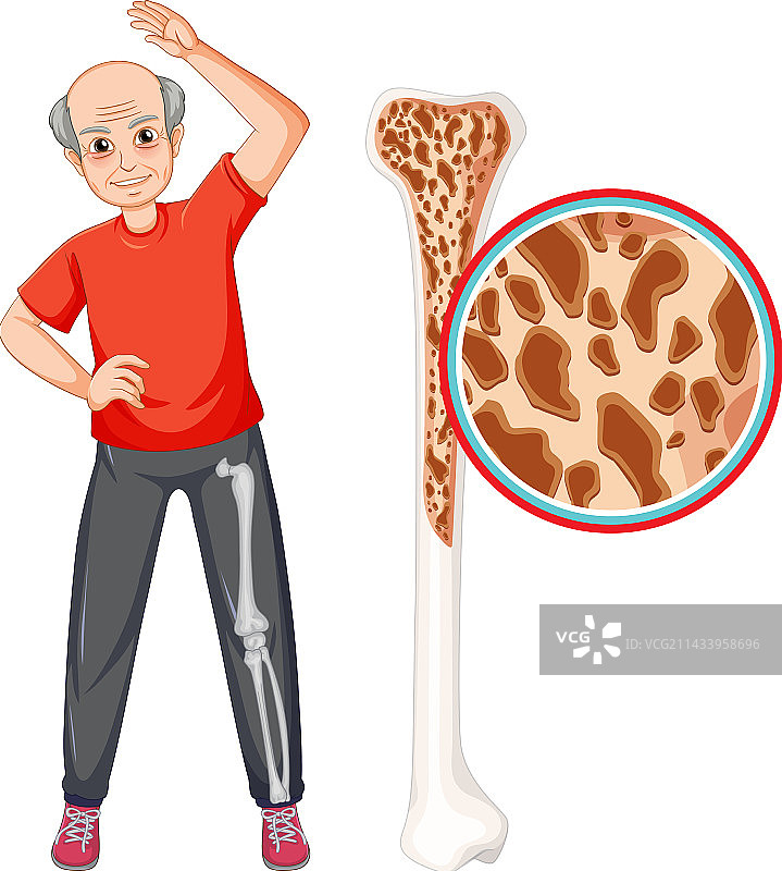 老年人骨质疏松症图片素材