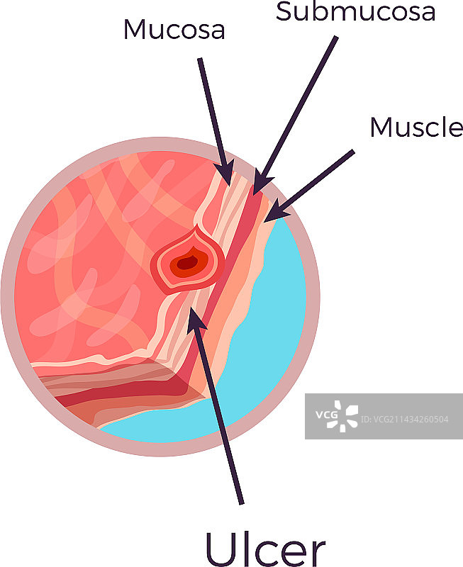 胃溃疡图片素材