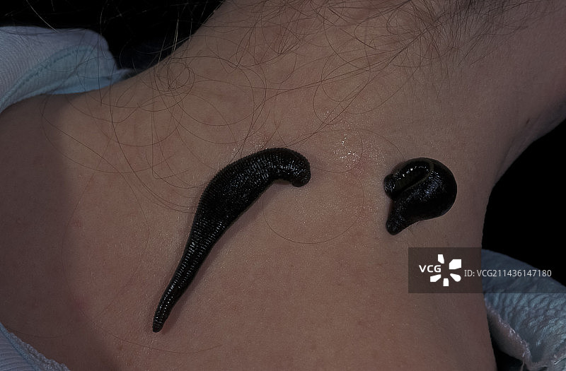 医用水蛭吸附在人的脖子上，欧洲图片素材