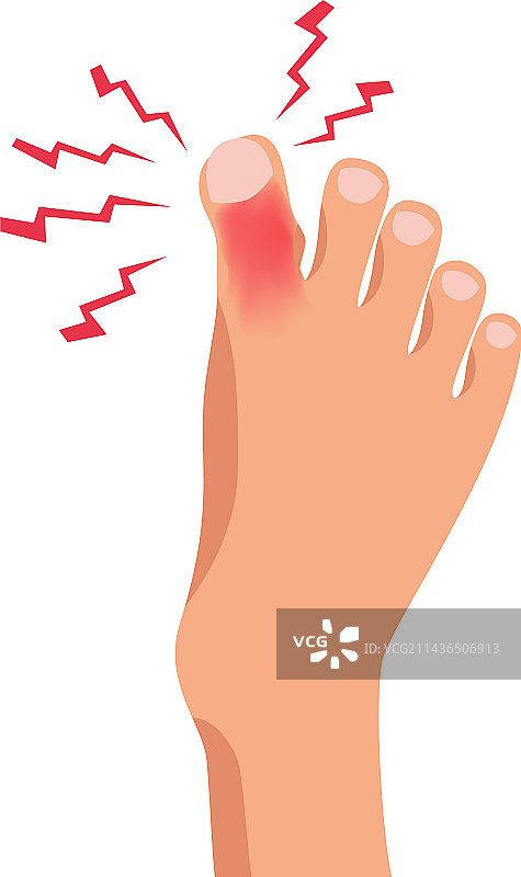 扁平足损伤图片素材