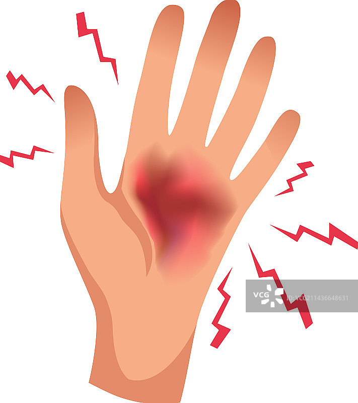 手掌烧伤扁平设计图片素材