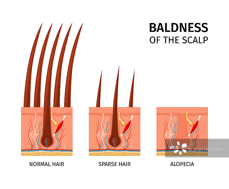 头皮秃顶结构图片素材