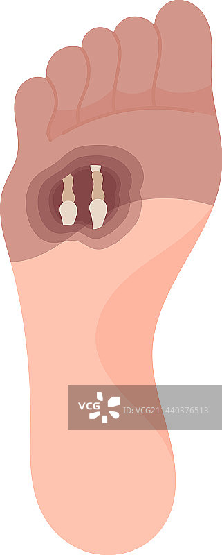 前足坏疽图片素材