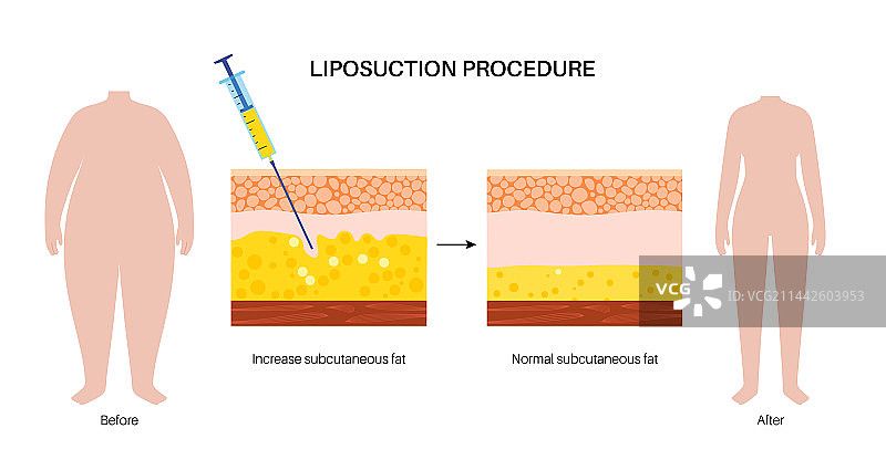抽脂手术图片素材