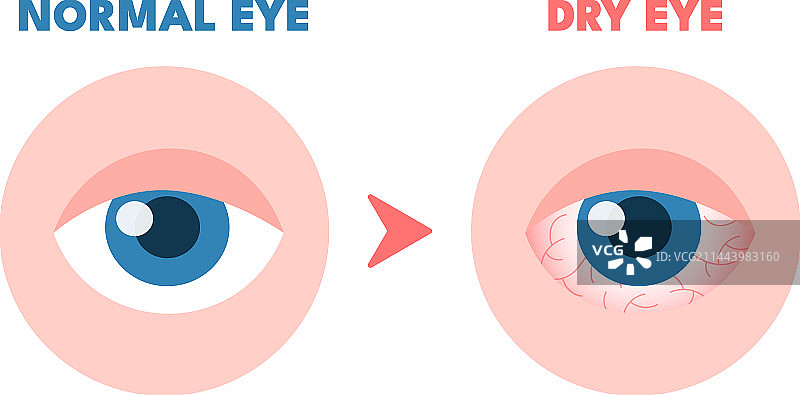 眼睛干涩，眼部健康问题图片素材