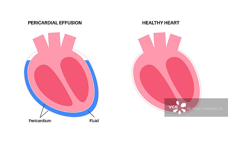 心包积液心图片素材