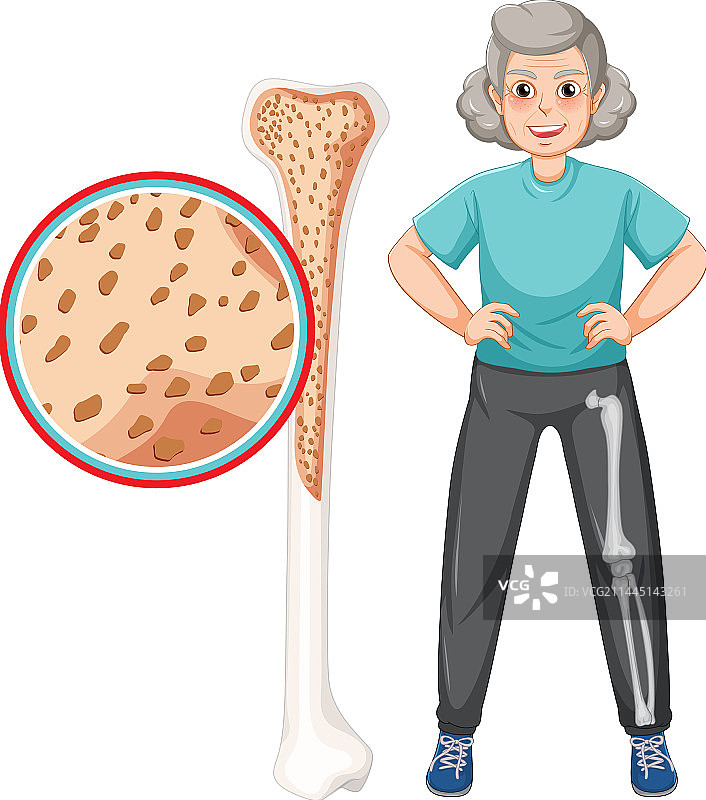 老年人骨质疏松症图片素材