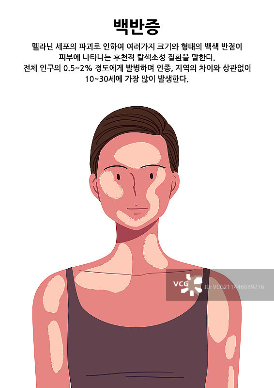 皮炎、皮肤问题、压力、疾病、白癜风图片素材